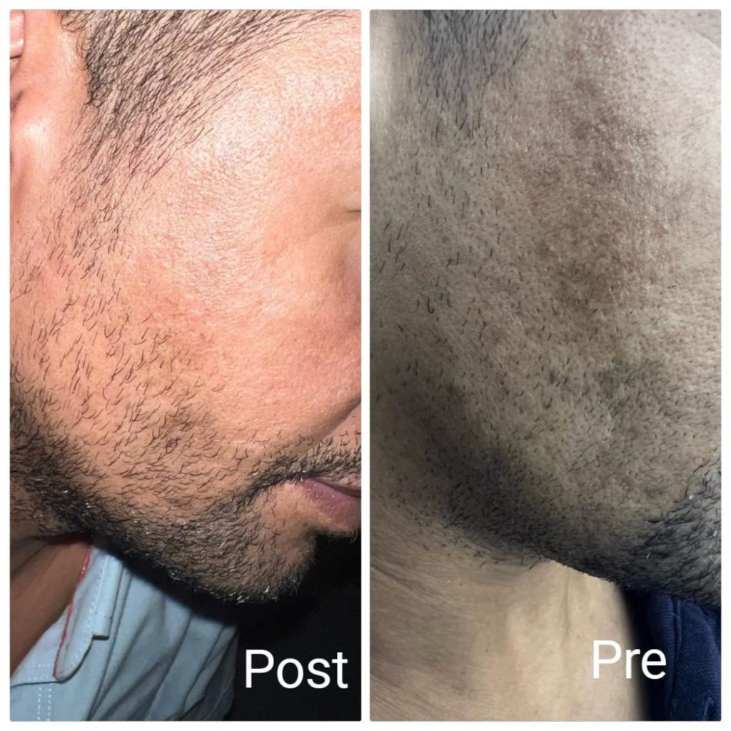 توحيد لون الوجه